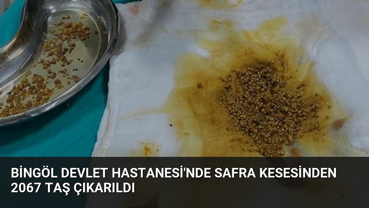 Bingöl Devlet Hastanesi’nde Safra Kesesinden 2067 Taş Çıkarıldı